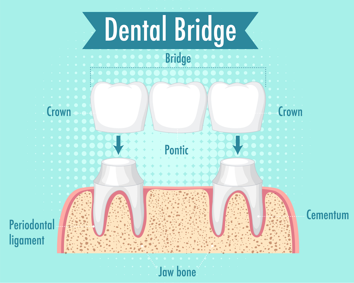 Dental bridge infographic