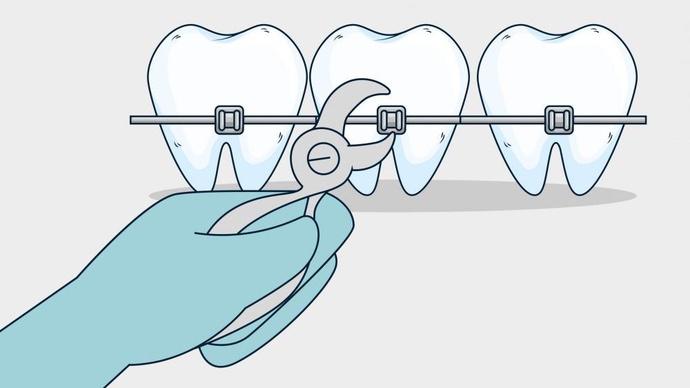 All treatments for straightening teeth involve some time, effort and cost, so for some it will not be worth it.