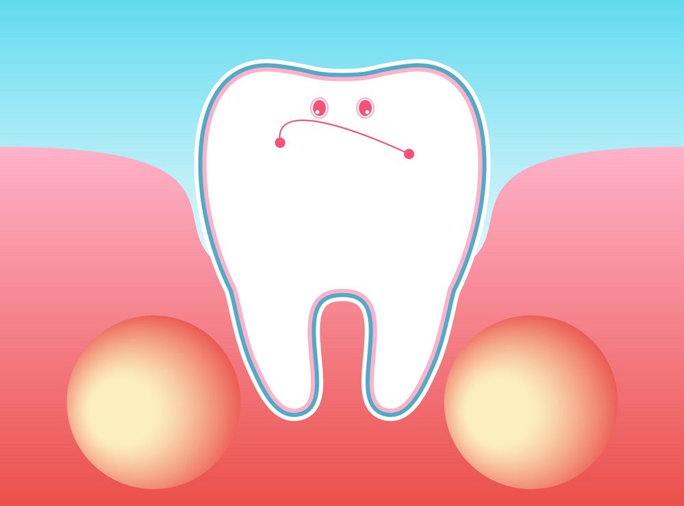 dental-abscess